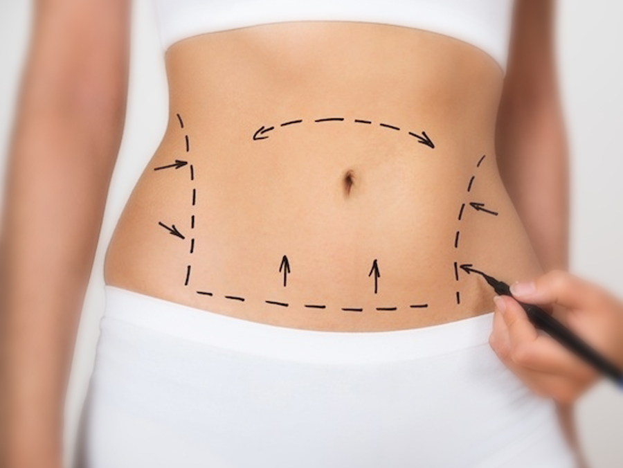 Liposuction