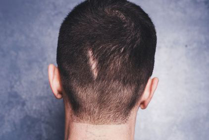 Scar Revision